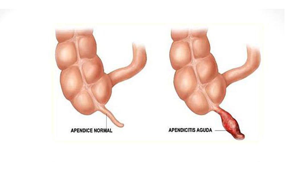 Experto del Seguro Social señala causas de la apendicitis