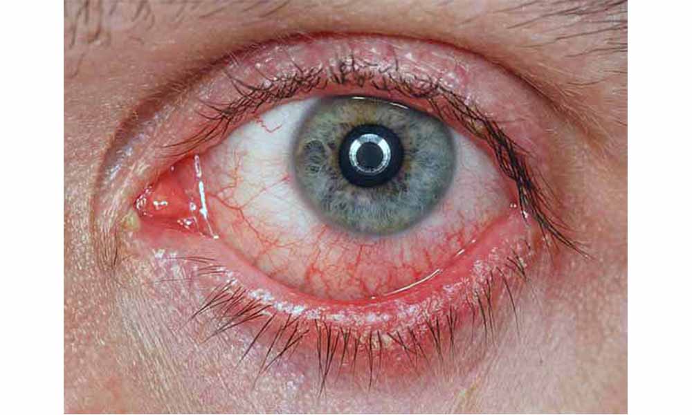 Conjuntivitis, cataratas y miopía, principales problemas de la vista