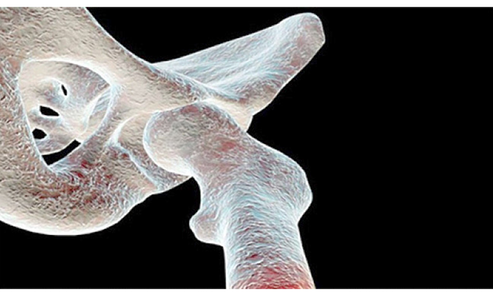 Fracturas de cadera ponen en riesgo vida de adultos mayores
