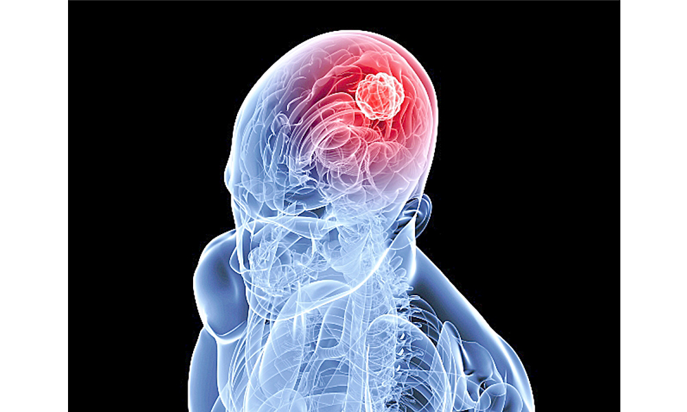 Infartos cerebrales silenciosos causa de demencia y derrames totales