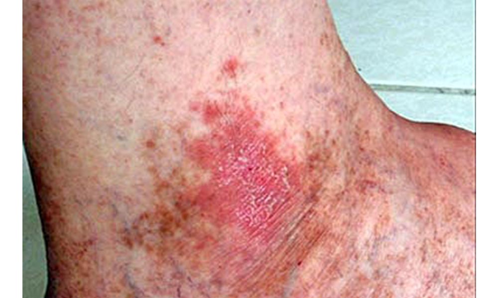 Inteligencia artificial eficaz para detectar el cáncer de piel