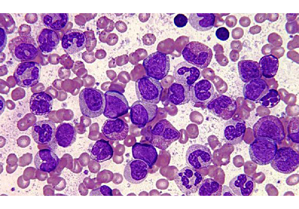 Leucemia linfocítica crónica afecta más a hombres adultos