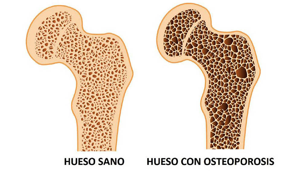 Falta de calcio y vitamina D ocasiona osteoporosis