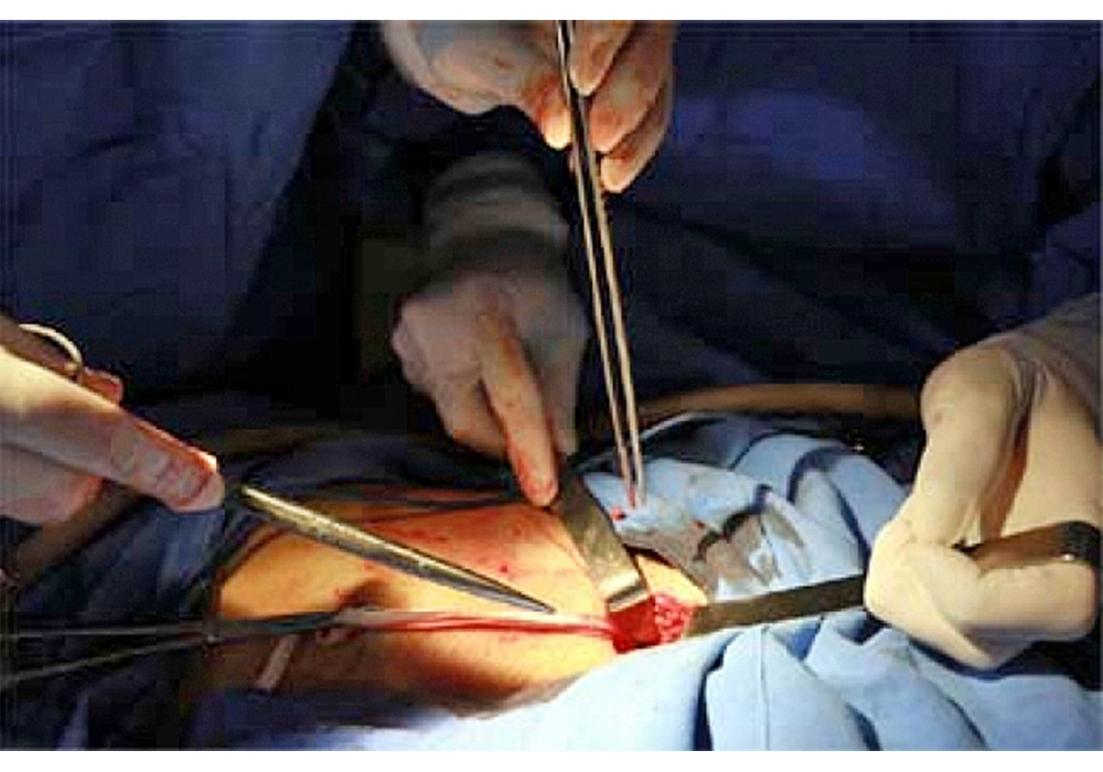 Cirugía bariátrica y bypass, opciones para pacientes con diabetes y obesidad