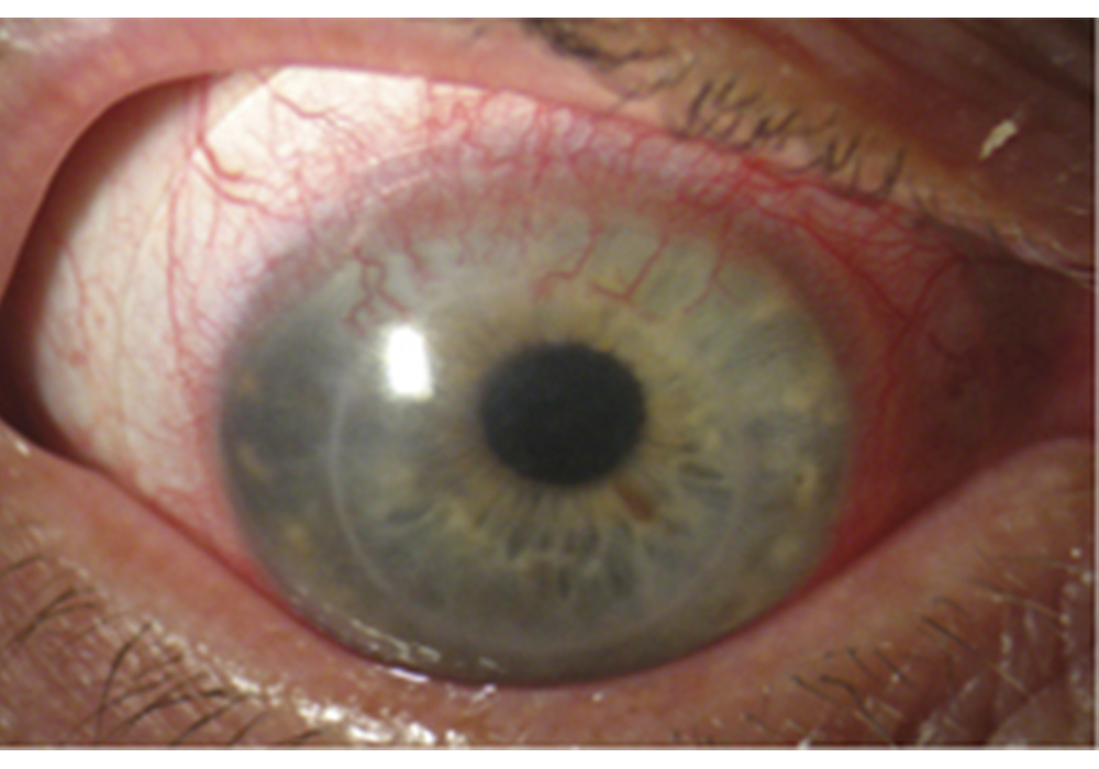 Glaucoma, es posible detenerla pero no revertir daños