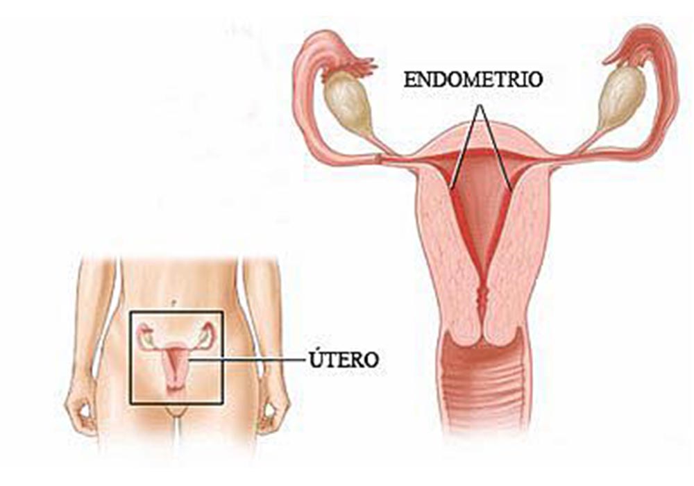 Microbios vaginales podrían indicar cáncer de endometrio
