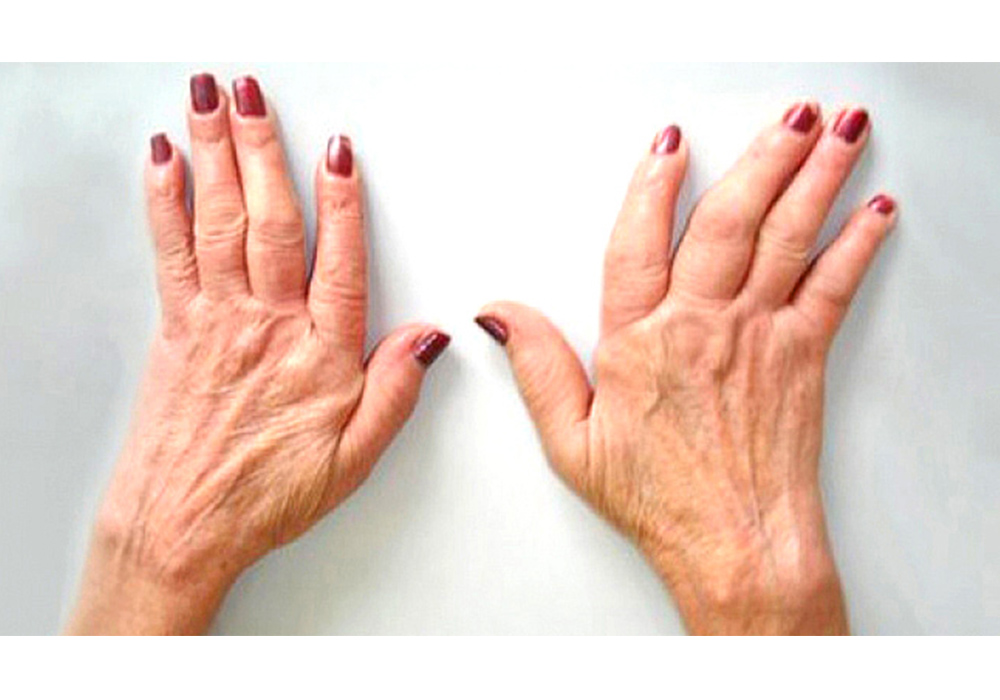 Osteoartritis, la principal causa de discapacidad en adultos mayores