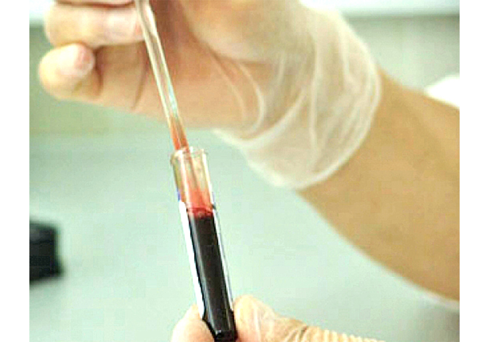 Examen de sangre permite detectar Síndrome del Intestino Irritable