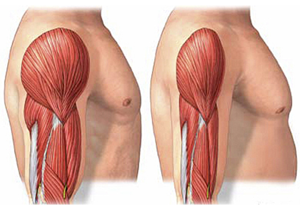 Falta de proteínas y pérdida de músculo en dietas provocan “rebote”: nutrióloga