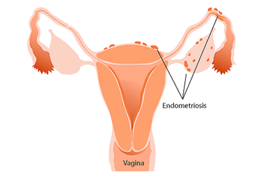 Endometriosis, tercera causa de infertilidad en la mujer