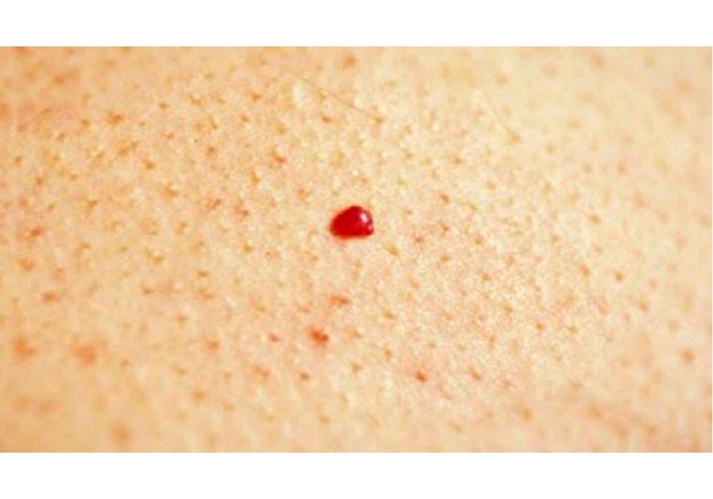 Lunares de sangre, signo de envejecimiento de la piel
