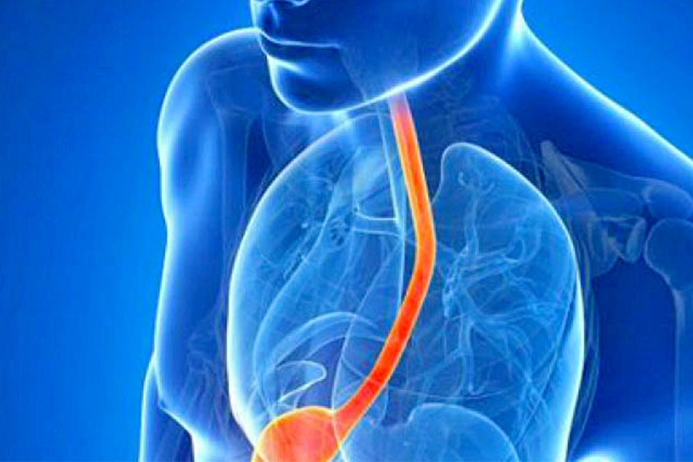 Tratamiento oportuno para reflujo reduce riesgo de cáncer esofágico