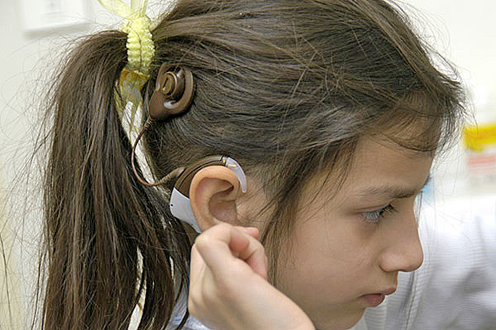 Los implantes cocleares: una manera diferente de ‘oír’