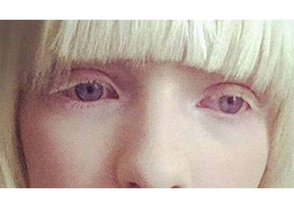 Sensibilización sobre el Albinismo