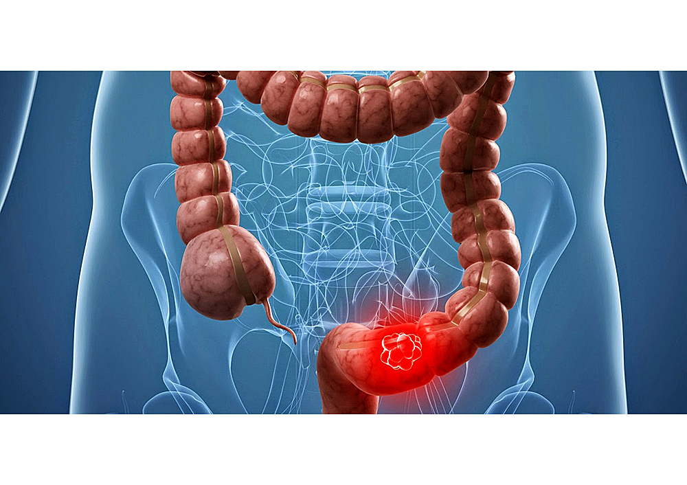 Personas cada vez más jóvenes padecen cáncer colorrectal 