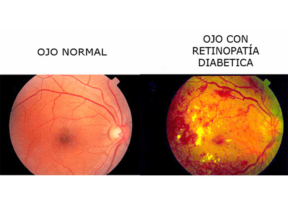 Retinopatía diabética, una de las principales causas de ceguera