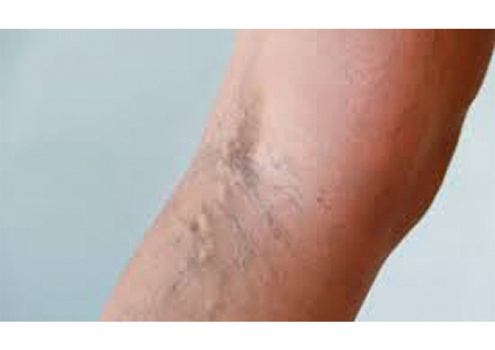 Invitan a varones a protegerse ante riesgo de trombosis por várices