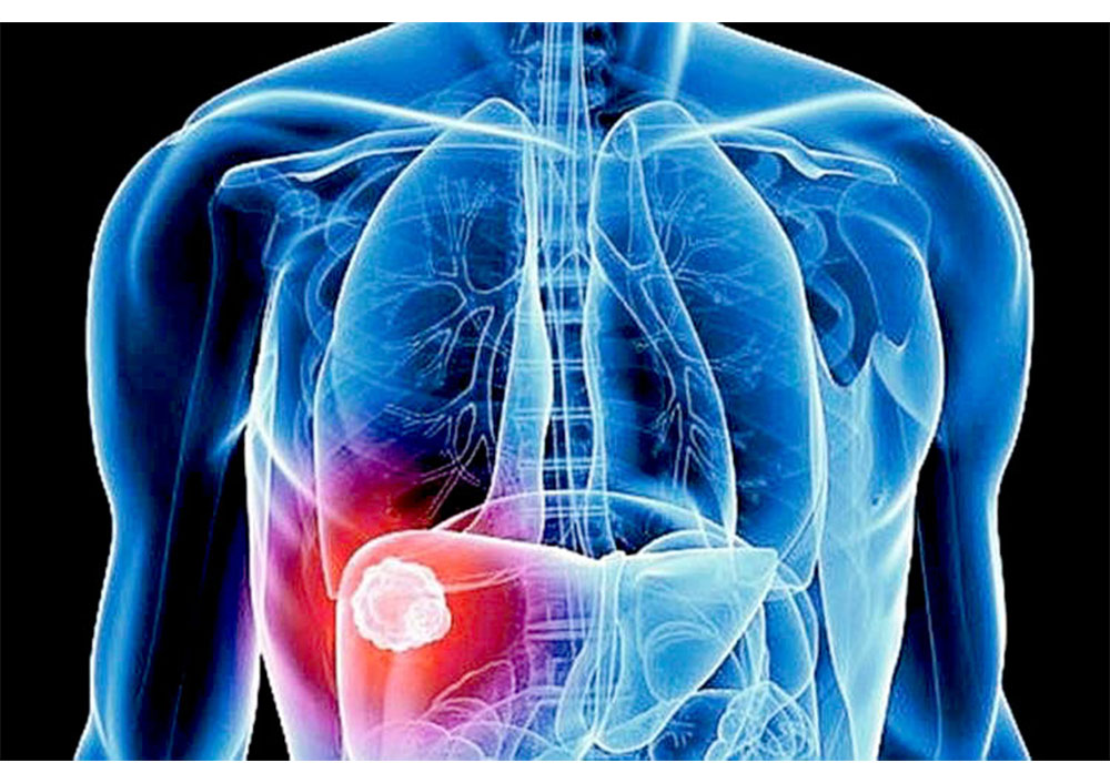 Son mujeres las más afectadas por inflamación de la vesícula biliar