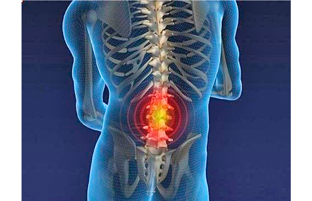 Obesidad y estrés, provocan cada vez más dolor de ciática: experto