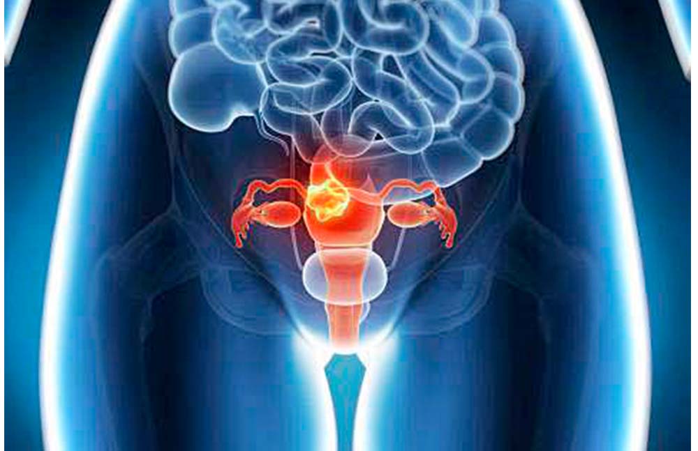 Miomas, responsables de hasta 40 por ciento de casos de infertilidad