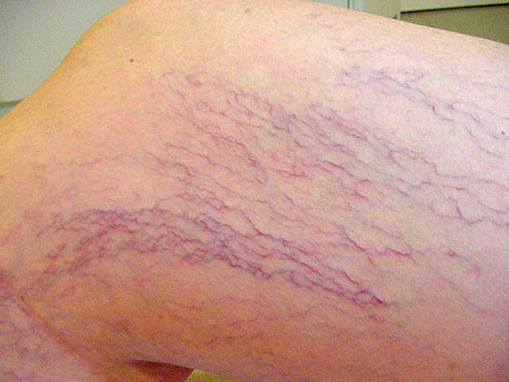 Embarazo triplica riesgo de padecer várices, afirman especialistas