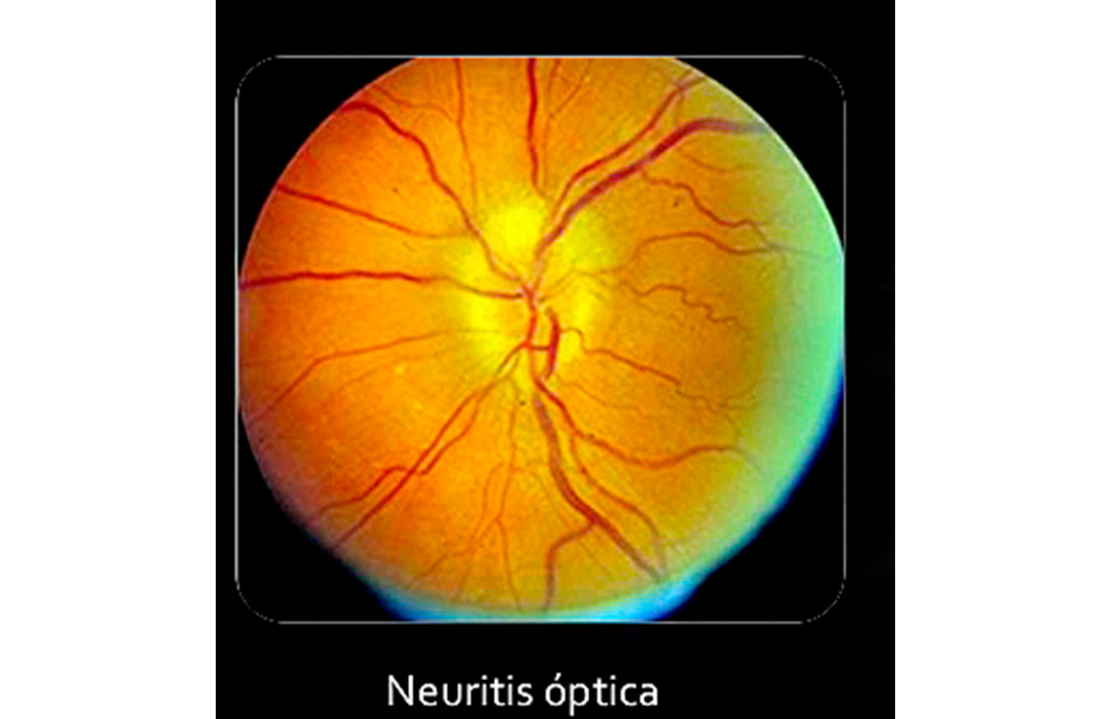 Diagnóstico oportuno de enfermedad de Devic puede evitar daños permanentes