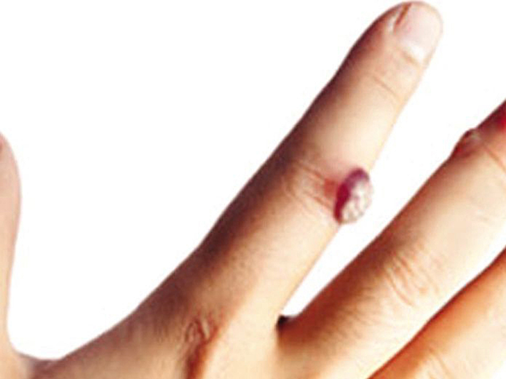 Mezquinos en la piel advierten presencia del virus del papiloma humano