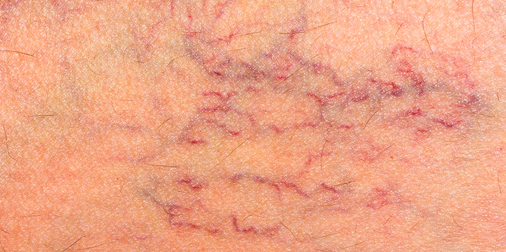 Recomiendan caminar diario para evitar várices