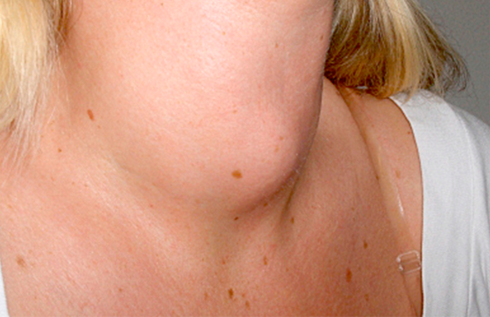 Consumo de alcohol y tabaco, asociado a cáncer de boca y laringe