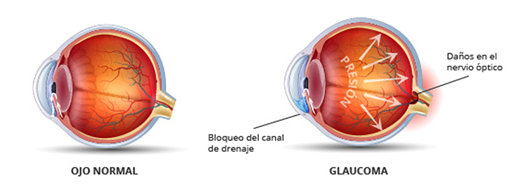 Estudio sugiere que el glaucoma puede ser una enfermedad autoinmune
