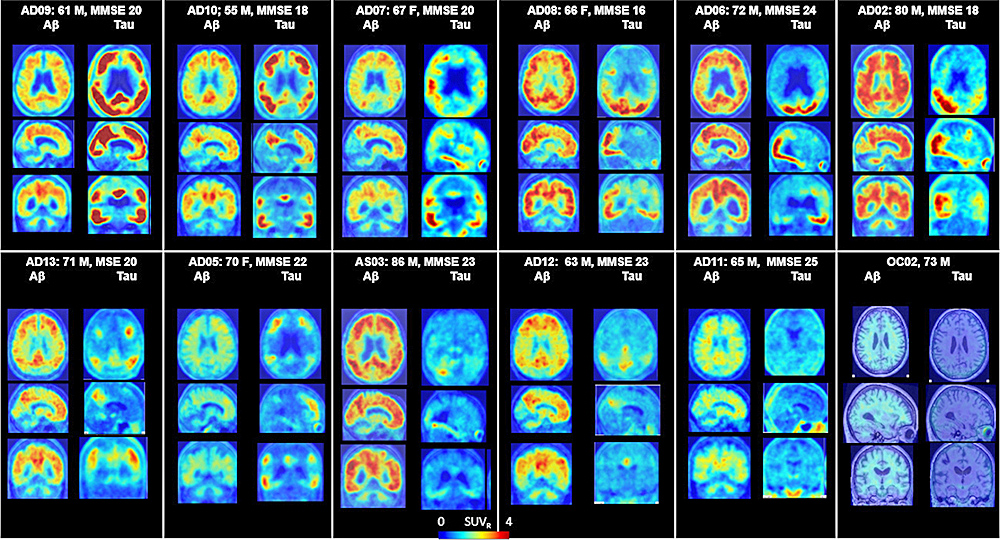 Johns Hopkins identifica técnica prometedora para diagnóstico de Alzheimer