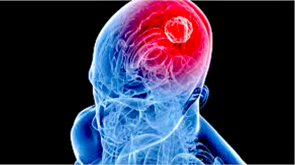 Desarrollan en Taiwán nuevo método para tratamiento del cáncer cerebral