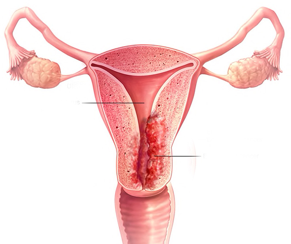 Cáncer de endometrio, el más común de los tumores uterinos