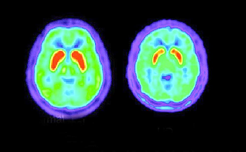 Depresión persistente en mayores de 40 años podría ser Huntington