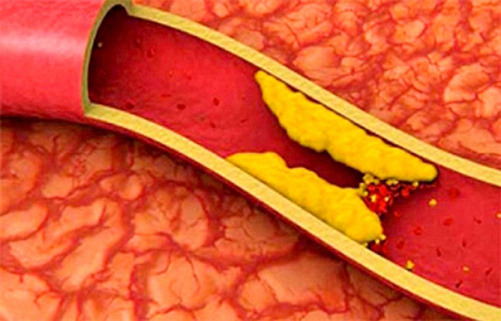 Colesterol alto por herencia es causa de infartos prematuros