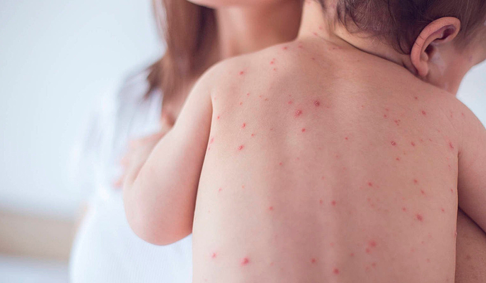 Repunta con fuerza el sarampión en el mundo, alerta la OMS