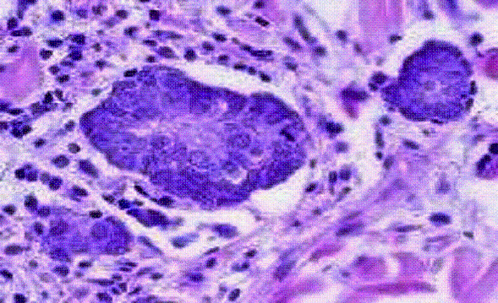 Cáncer de células de Merkel, raro pero agresivo tumor en la piel