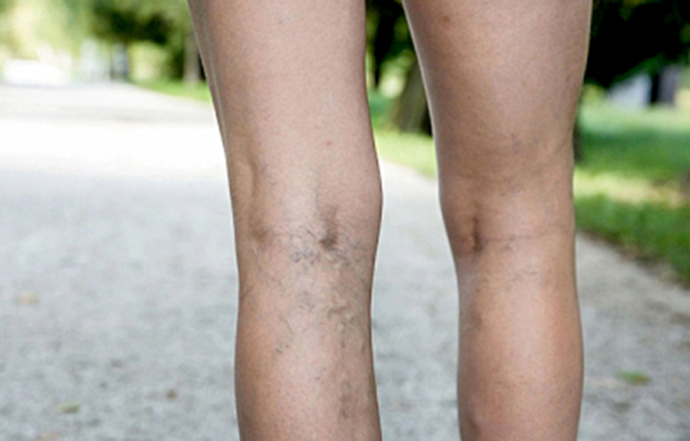 Estatura es factor de riesgo para desarrollar várices