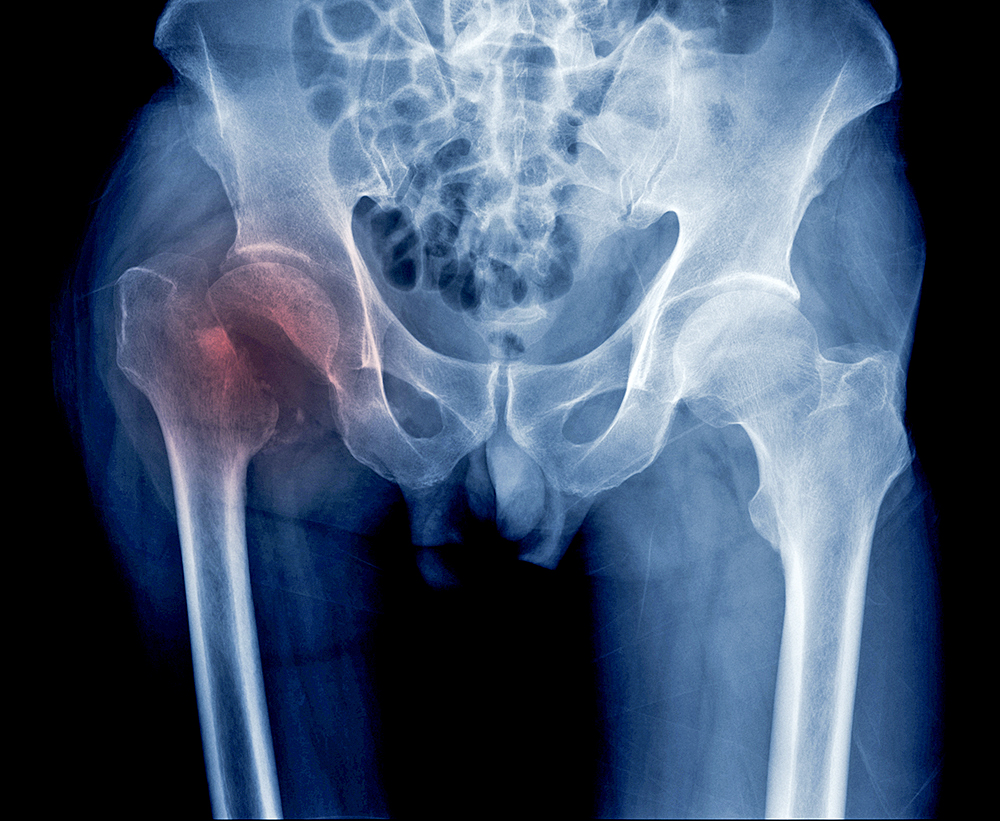 Fracturas de cadera pueden ser un signo temprano de Alzheimer en personas mayores 