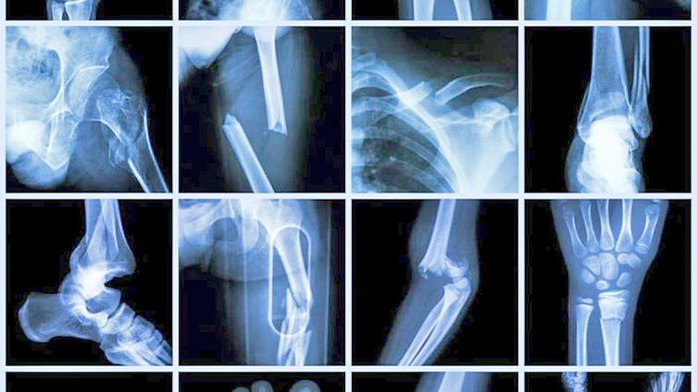 Reportan existencia de sistema de vasos sanguíneos en los huesos