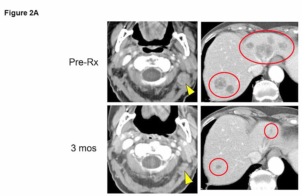 Inmunoterapia más eficaz que quimioterapia en tratamiento de cáncer cutáneo de gran malignidad