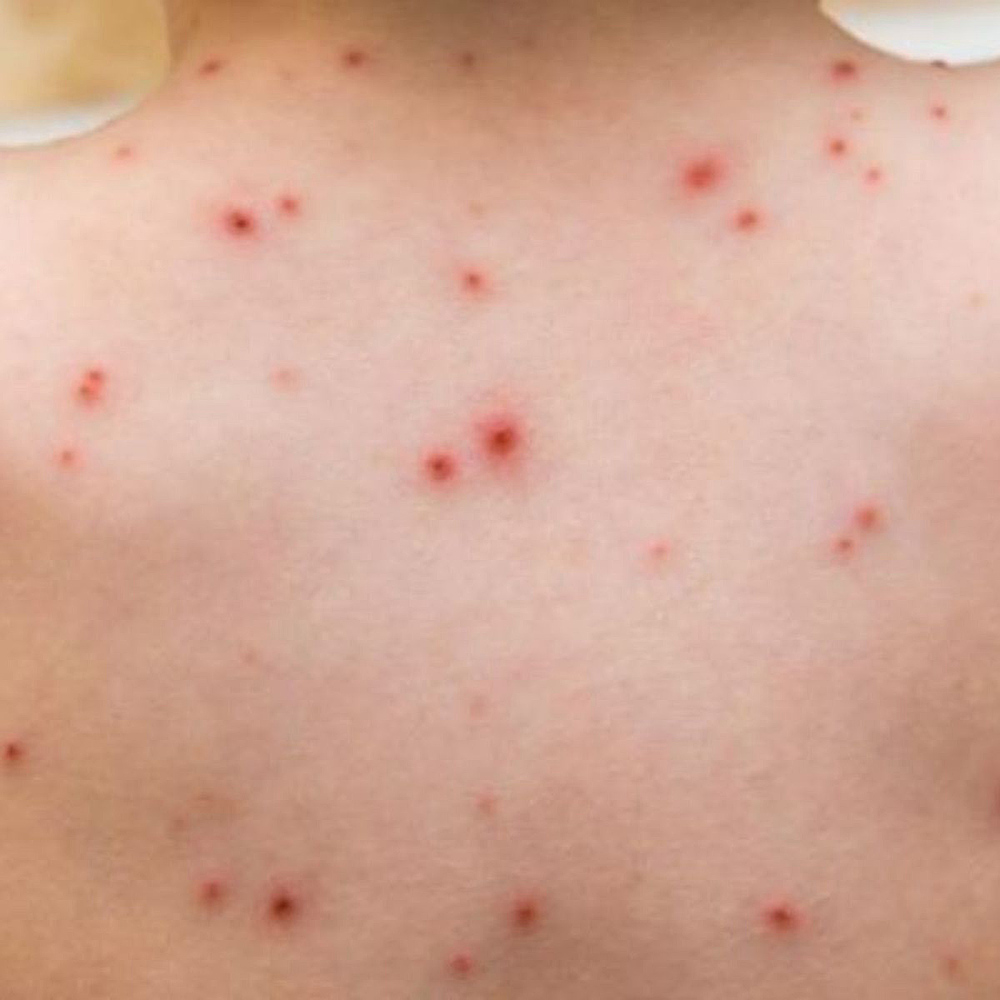 Alerta UNICEF sobre sarampión como amenaza creciente a la infancia