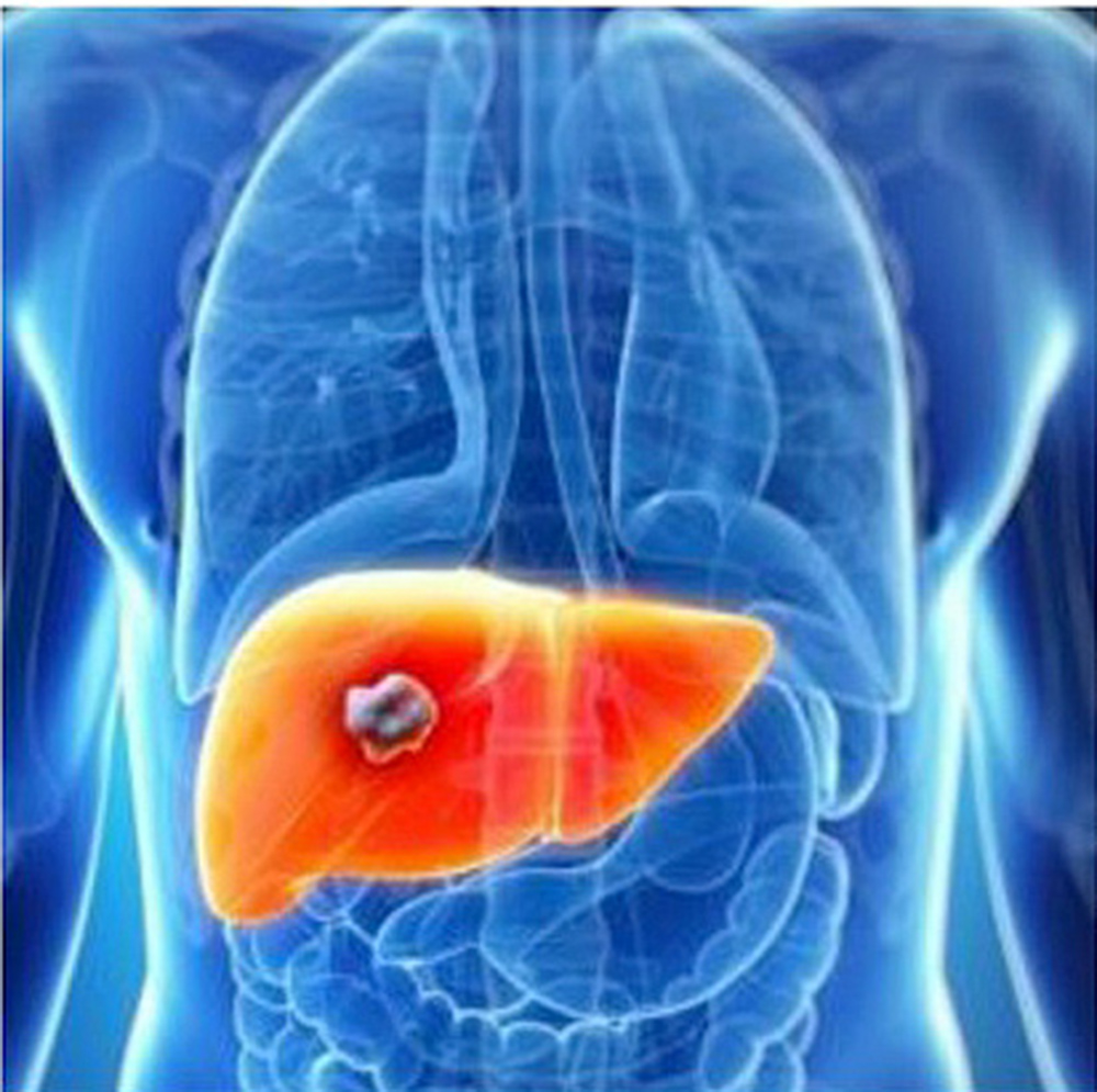 Nuevas opciones terapéuticas apoyan a pacientes con cáncer de hígado y de ovario