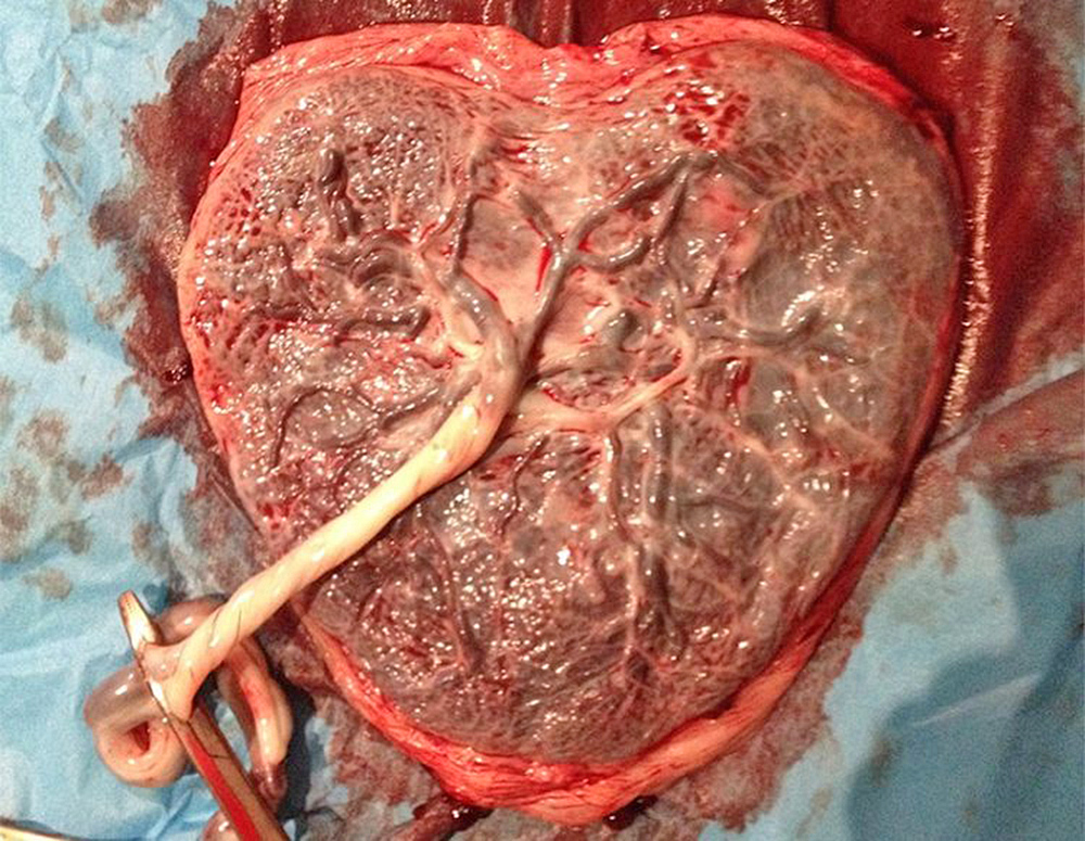 Aplican modelado 3D para identificar problemas en la placenta