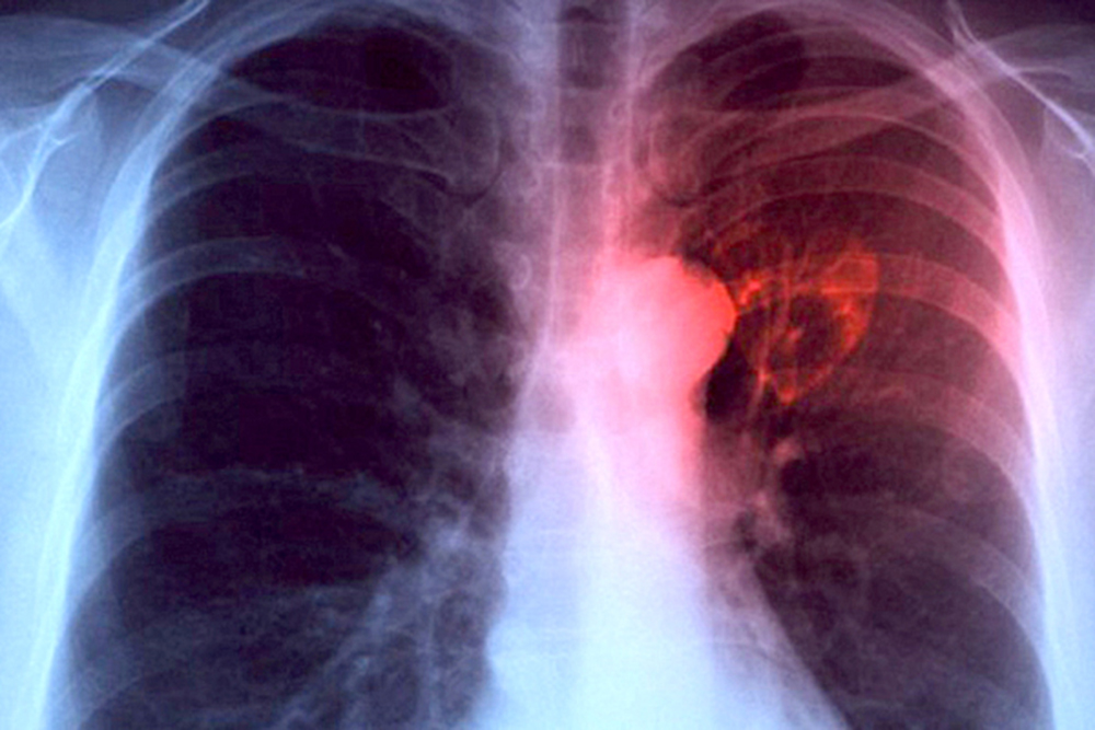 OMS pide al mundo “acabar” con la tuberculosis, el asesino más letal