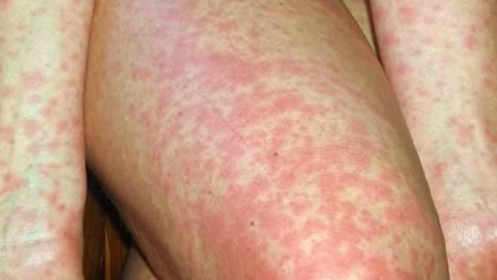 EUA enfrenta el segundo mayor brote de sarampión en casi dos décadas