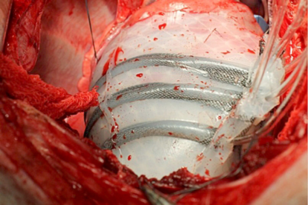 Desarrollan sistema robótico que ayuda al corazón a latir