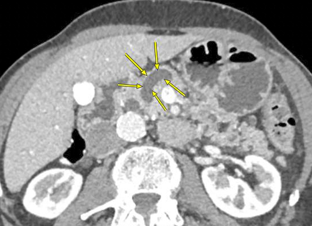 Resección temprana y frecuente de algunas neoplasias químicas del páncreas puede reducir riesgo de cáncer