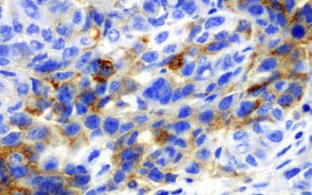 Ambiente ácido genera tumores más invasivos, revela estudio