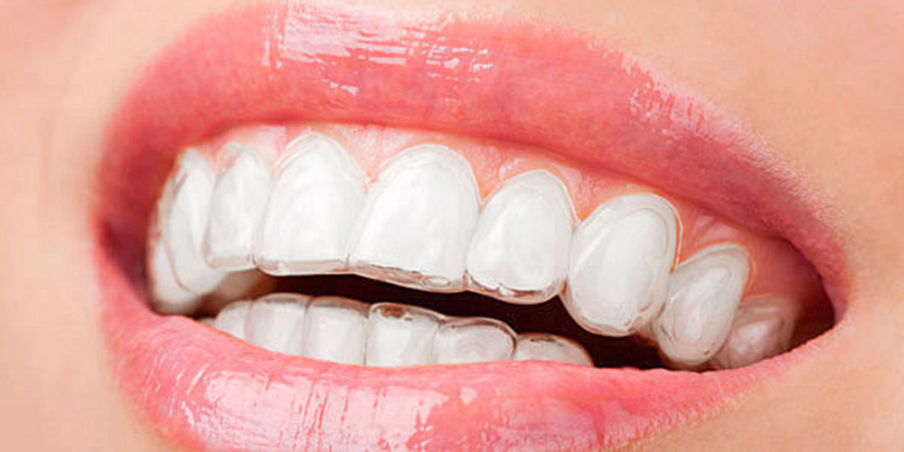 Aumentan casos de bruxismo en jóvenes por ansiedad y uso de dispositivos